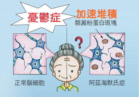 憂鬱會加速類澱粉堆積在大腦